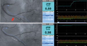 Document the function gain pre (top) & post (bottom) PCI