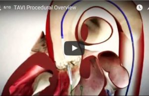 Using a hybrid OR for TAVI: A procedural overview