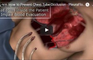 Surgeon-designed tool could be used to prevent acute and subacute complications after cardiac surgery