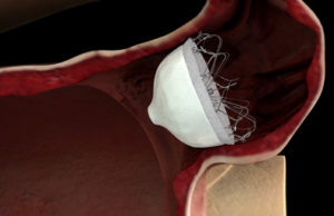 Biosense Webster acquires Coherex Medical