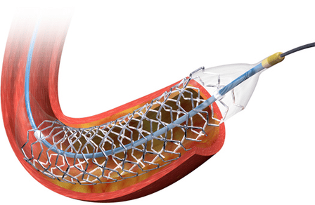 BioMatrix NeoFlex, one of the Biosensors products to be offered by Cordis