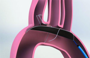 Pooled trial results show positive outcomes for Keystone Heart’s TriGuard