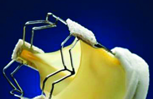 Medtronic reports 3f Enable five-year follow-up data