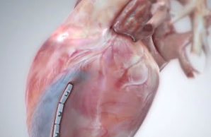 BioVentrix receives FDA investigative device exemption for ALIVE trial of Revivent