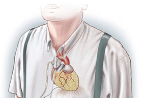 Sunshine Heart pauses enrolment in US pivotal study of C-Pulse heart assist system