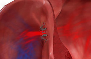 Corvia Medical receives FDA investigational device exemption approval for REDUCE LAP-HF study