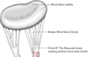 On-X Life Technologies to launch Chord-X mitral valve chordal repair system