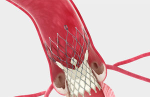 Medtronic CoreValve System ‘real-world’ US patient experience data replicates clinical outcomes