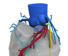 HeartFlow FFRCT Analysis can lower cost of care by up to 32% and improve quality of life for coronary artery disease