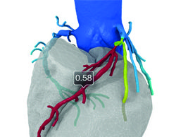 FDA allows marketing of non-invasive device to help evaluate heart blood flow