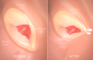Positive data for Mitralign percutaneous annuloplasty system presented at EuroPCR