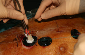 New approach for aortic valve replacement is feasible