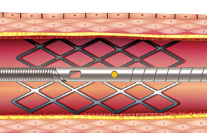 Opsens performs 1,000th procedure with the OptoWire
