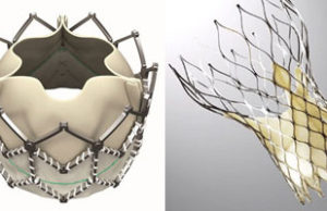 Neither valve design nor approach affect stroke rate after TAVI