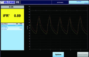 Final results of ADVISE II registry demonstrates performance and utility of iFR Modality
