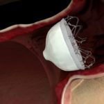 biosense-webster-acquires-coherex-medical