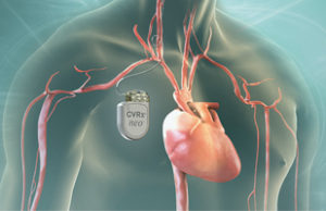 CVRx granted CE mark for the Barostim neo system for conditional MRI compatibility