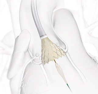 Medtronic CoreValve Evolut R