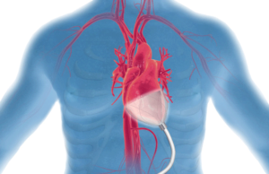 EpicHeart soft-robotic heart assist device wins innovation award