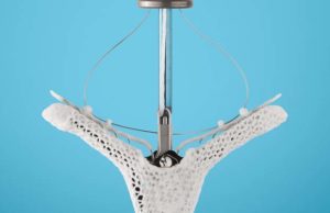 MitraClip in moderate surgical risk patients