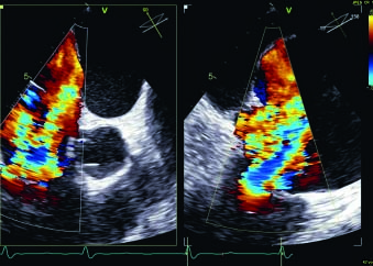 ADVERTORIAL: Tricuspid annular reduction using Cardioband Tricuspid