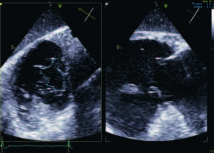 ADVERTORIAL: Tricuspid annular reduction using Cardioband Tricuspid