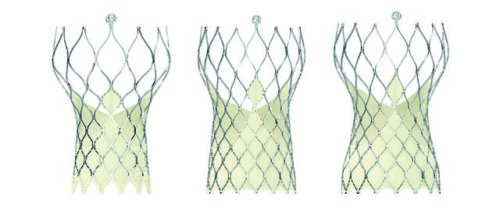 Evolut R Sizes Evolut R superior to surgery at one year in intermediate-risk patients CN