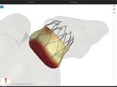 CE mark for the FEops HEARTguide