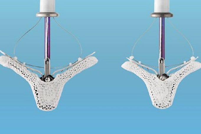 Abbott gets green light for trial on MitraClip in moderate surgical risk patients