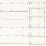 Atrial fibrillation