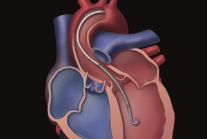 Impella in Heart