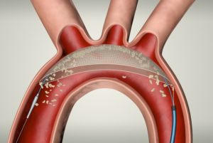 The TriGUARD 3 CEP device in the aortic arch