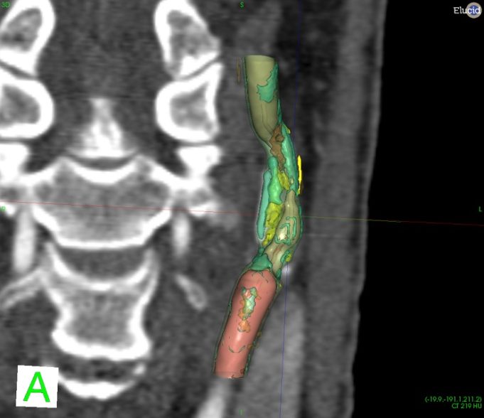 Proximo Medical named as commercialisation partner for Elucid Bioimaging