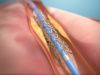 DynamX coronary bioadaptor gains approval from Japanese MHLW