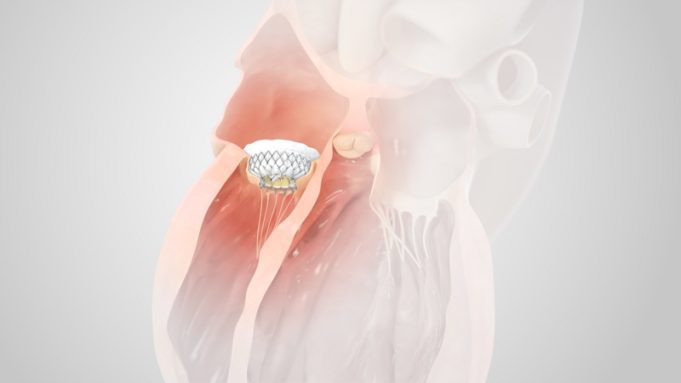Medtronic begins early feasibility study of the Intrepid transcatheter valve system
