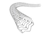 Advertorial: Stent overexpansion is key to overcoming variable diameter in complex PCI cases