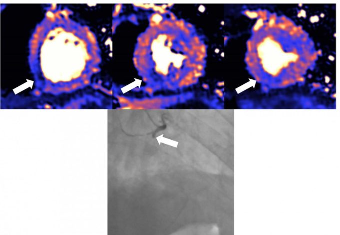 MRI study of COVID-19 patients with raised troponin levels reveals high rate of heart damage