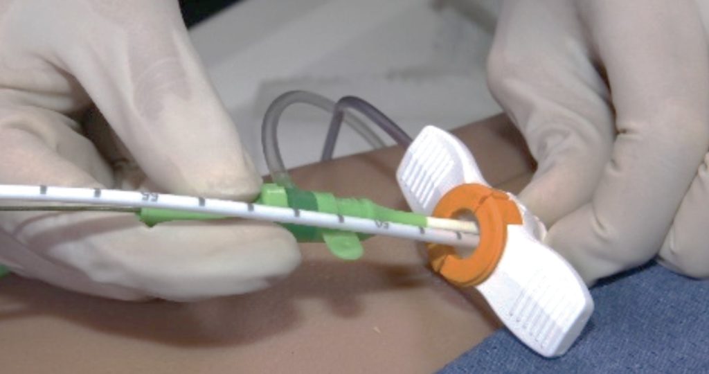 Approval allows use of single access Impella procedure across Europe ...