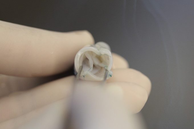 Lab-grown heart valves capable of growth in recipient, research finds