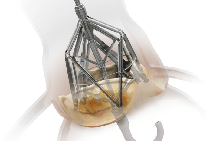 Leaflex: Changing the conversation around aortic stenosis?