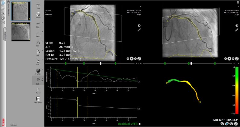 FASTIII trial of angiography-based vessel fractional flow reserve ...