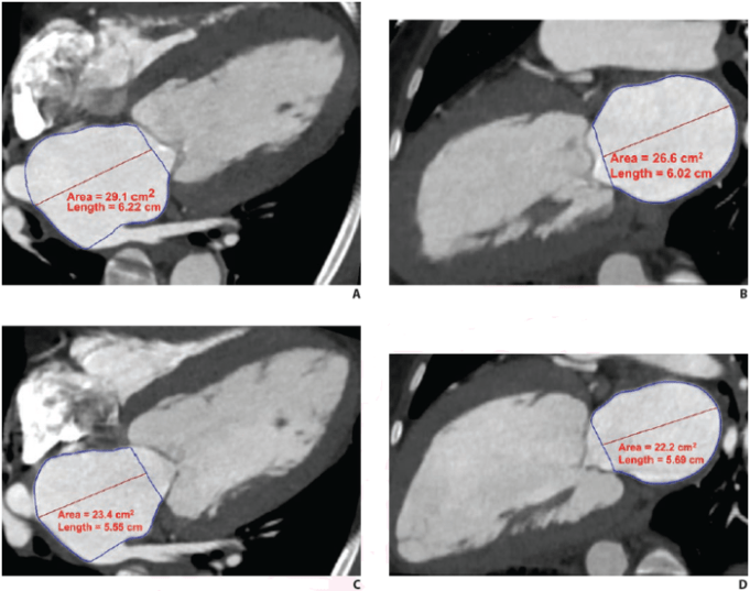 Cardiac CTA parameters predict post-TAVI mortality