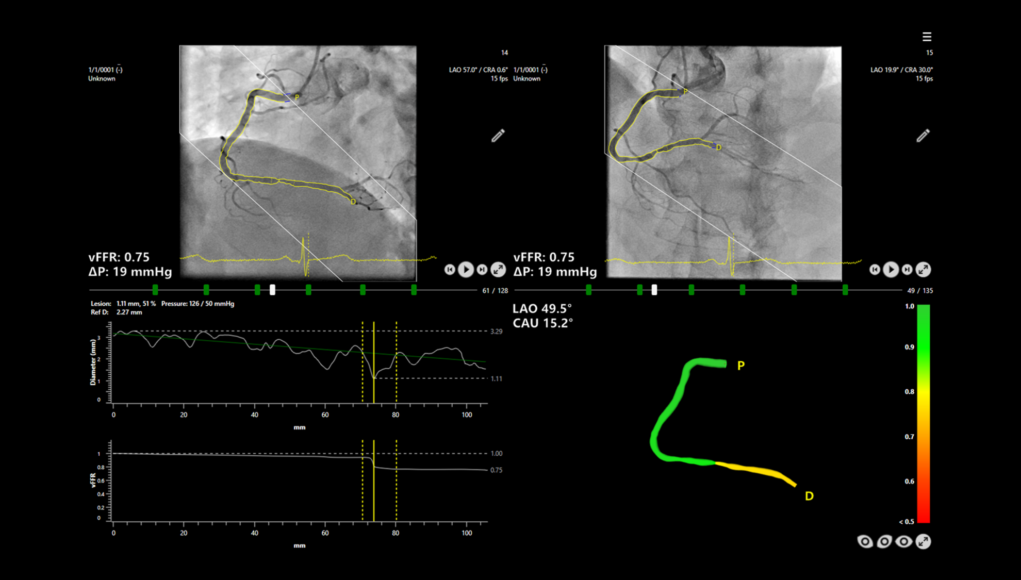 First patients enrolled in FAST III study of vFFR-guided PCI ...
