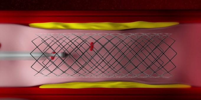 Coronary artery modelling technology enables 3D reconstruction of coronary vasculature