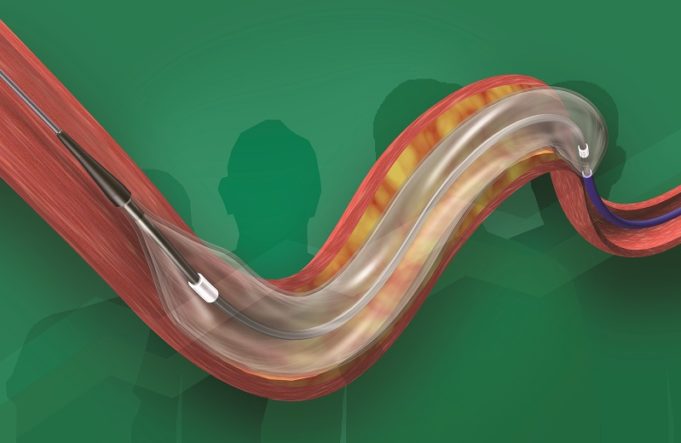 First patient enrolled in RISE SC study of coronary balloon