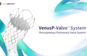 VenusP-Valve