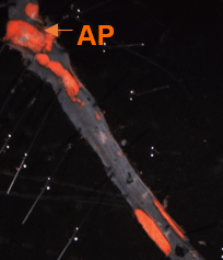 atherosclerosis