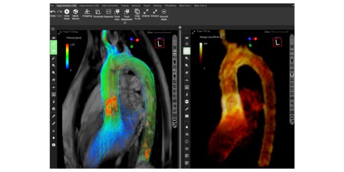 iTFlow blood flow analysis software gains US FDA approval