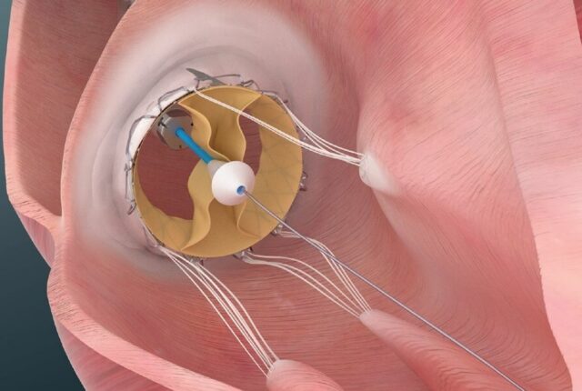 First two US patients receive Trisol tricuspid valve