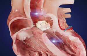 Xenter unveils dual-sensor TAVI guidewire